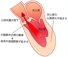 大動脈弁狭窄症