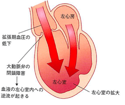 大動脈弁閉鎖不全症