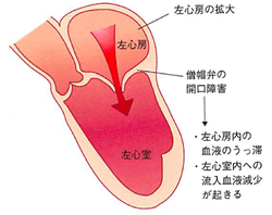 僧帽弁狭窄症