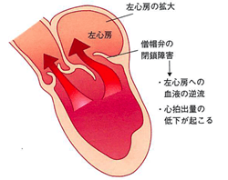 僧帽弁閉鎖不全症