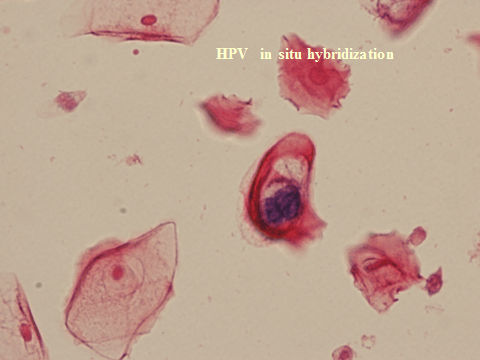 HPV is situ hybridization
