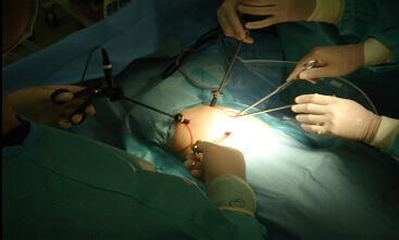 胸腔鏡手術風景
