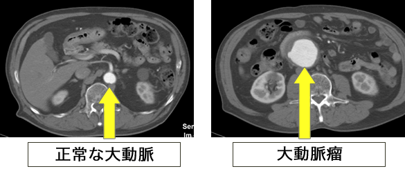 大動脈瘤