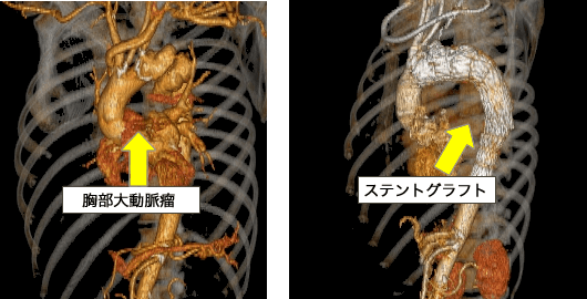 胸部大動脈瘤・ステントグラフト