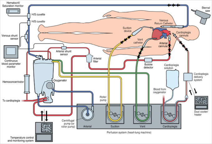 人工心肺回路図