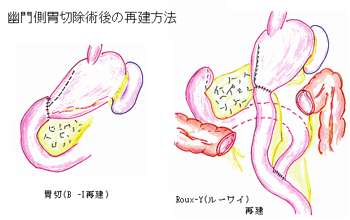 幽門側胃切除術後の再建方法