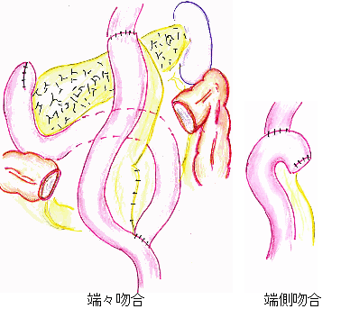 Roux-Y(ルーワイ)再建